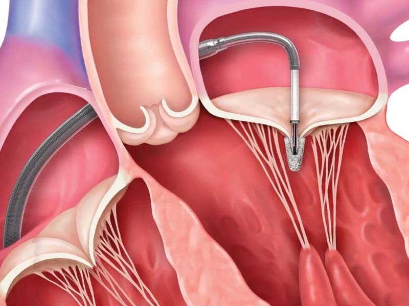 افتادگی دریچه میترال چیست و چه خطراتی دارد؟